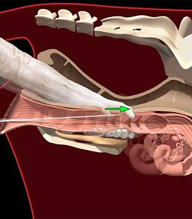Ректоцервикальная техника искусственного осеменения